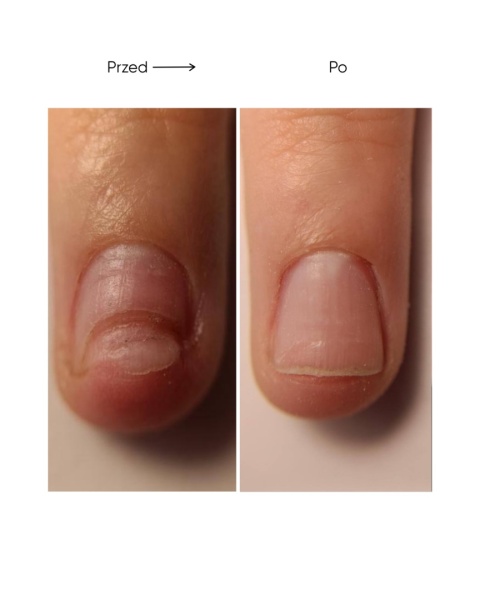 Resultum Onistopix Oil – olejek regenerujący dla paznokci z onycholizą, 15 ml