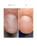 Resultum Onistopix Oil – olejek regenerujący dla paznokci z onycholizą, 15 ml