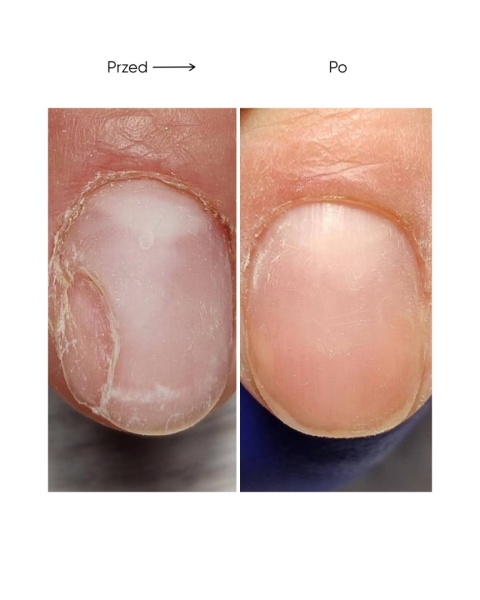 Resultum Onistopix Oil – olejek regenerujący dla paznokci z onycholizą, 15 ml