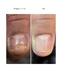 Resultum Onistopix Oil – olejek regenerujący dla paznokci z onycholizą, 15 ml
