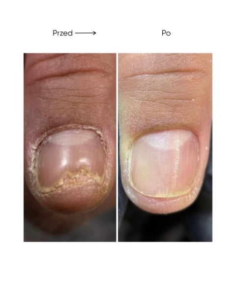 Resultum Onistopix Oil – olejek regenerujący dla paznokci z onycholizą, 15 ml