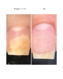 Resultum Onistopix Oil – olejek regenerujący dla paznokci z onycholizą, 15 ml