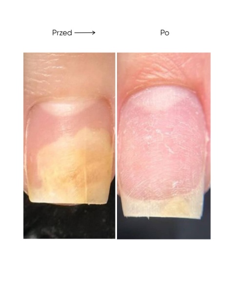 Resultum Onistopix Oil – olejek regenerujący dla paznokci z onycholizą, 15 ml