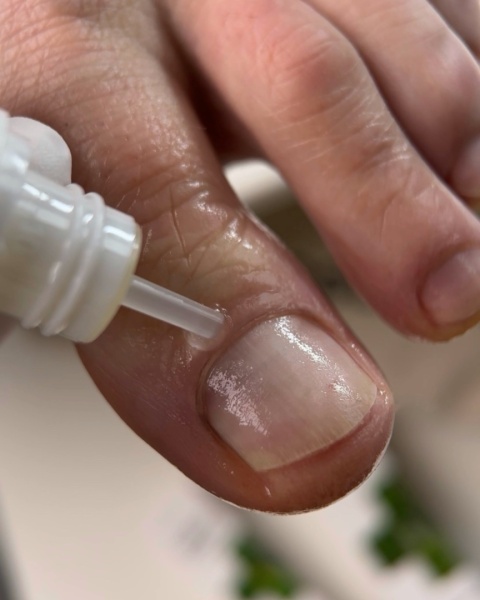 Resultum Onistopix Oil – olejek regenerujący dla paznokci z onycholizą, 8 ml
